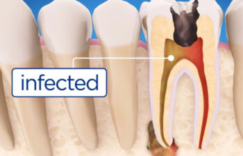 illustration of tooth infection requiring root canal therapy