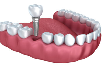 illustration of a lower jaw demonstrating how dental implants work