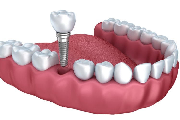 Finding the Best Dental Implants Dentist Curtis Family Dentistry