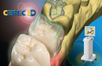 cerec same day crown illustration