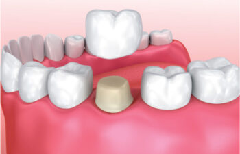 Are Dental Crowns Noticeable? Mooresville, NC