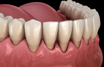 what causes gum recession, receding gums on lower teeth